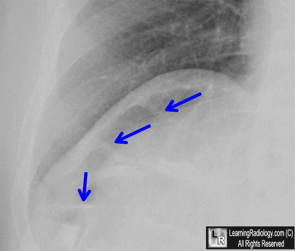 Chilaiditi&rsquo;s Sign Syndrome